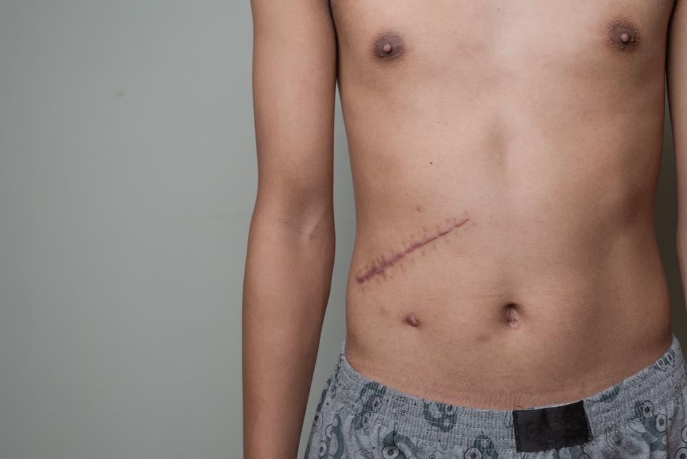 Shockwave Therapy for Scar Tissue