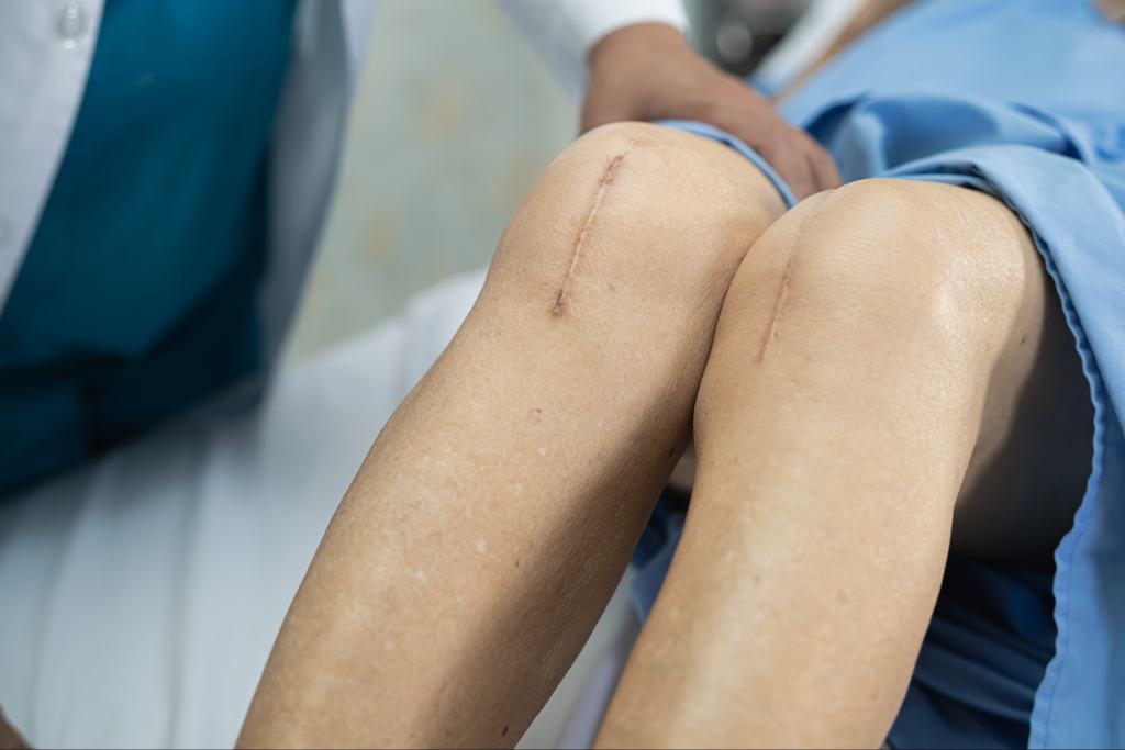 How to Break Up Scar Tissue in Knee Without Surgery