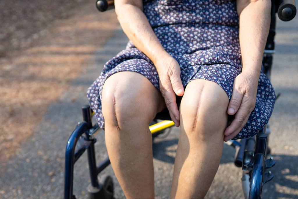 What Is Scar Tissue in the Knee and Why Does It Form?