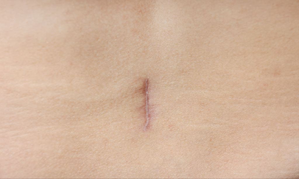 Scar Tissue Pain After Surgery- Symptoms, Causes, and Relief Options