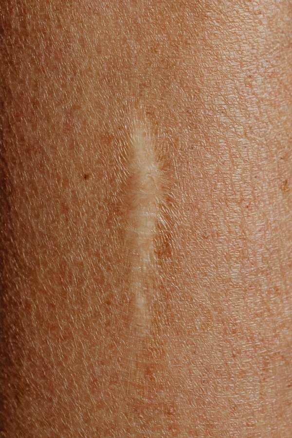 Scar Tissue Pain After Surgery—Causes & Gentle Relief Methods